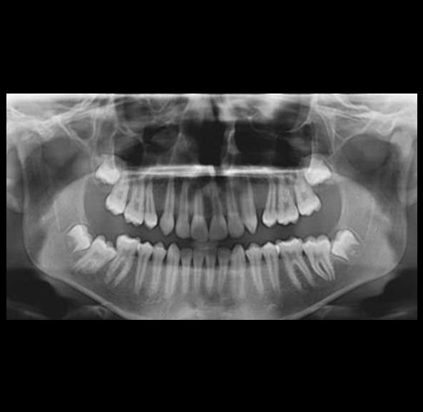 wisdom teeth xray from North County Cosmetic and Implant Dentistry in